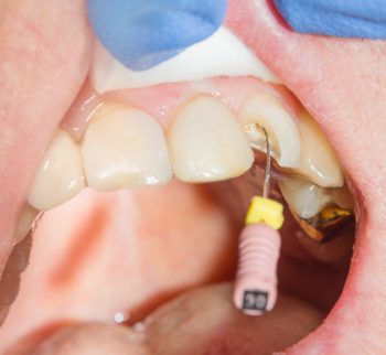 Endodontics